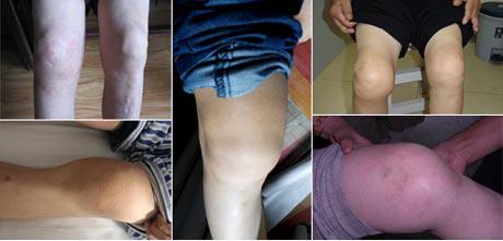 ֣��ʹ���ʪ��ҽԺ�ؽ���ʹ����Ӳ.jpg