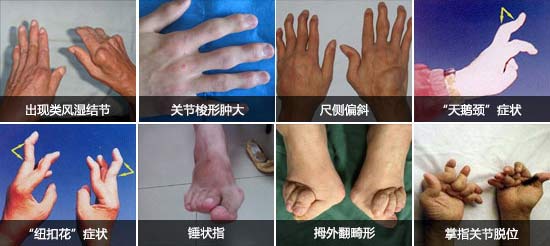 ֣��ʹ���ʪ��ҽԺ���ʪ�������ָ����ֺ�ȶദ�ؽڻ���.jpg