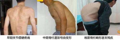 ֣��ʹ���ʪ��ҽԺǿֱ�Լ����׵ĸ���֢״����ͼ.jpg