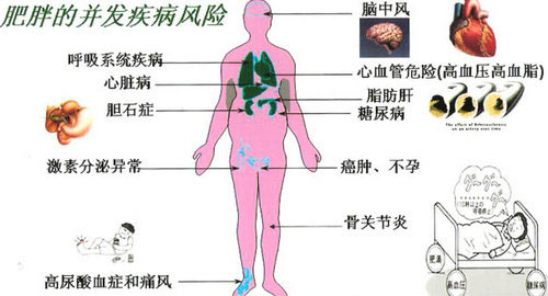郑州痛风风湿病医院肥胖的并发疾病.jpg